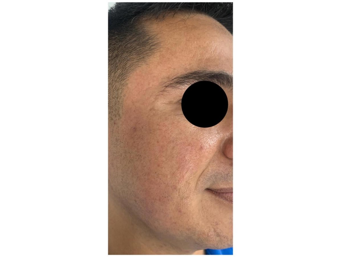 Antes y después — Después