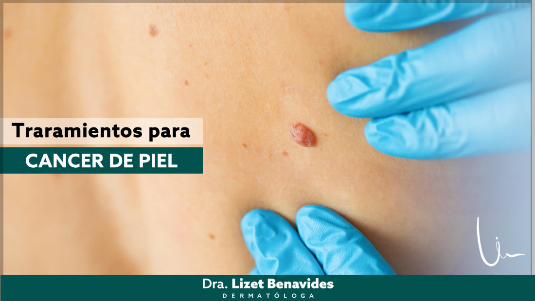 Dra. Lizet Benavides Dermatóloga