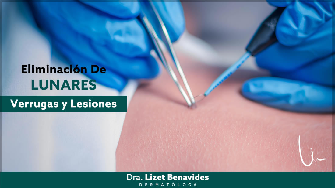 Dra. Lizet Benavides Dermatóloga